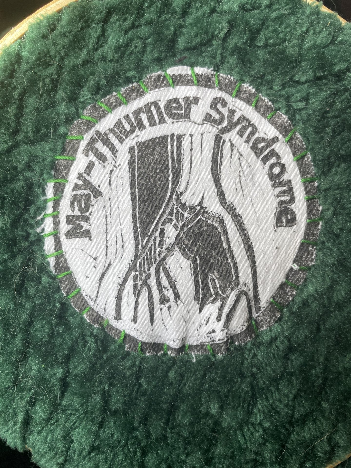 May-Thurner Syndrome Patch